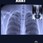 Xray